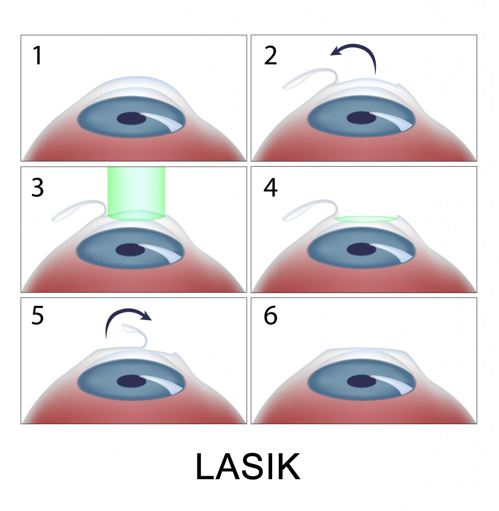 Cirurgia Refrativa Lasik
