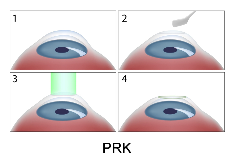 Cirurgia Refrativa PRK