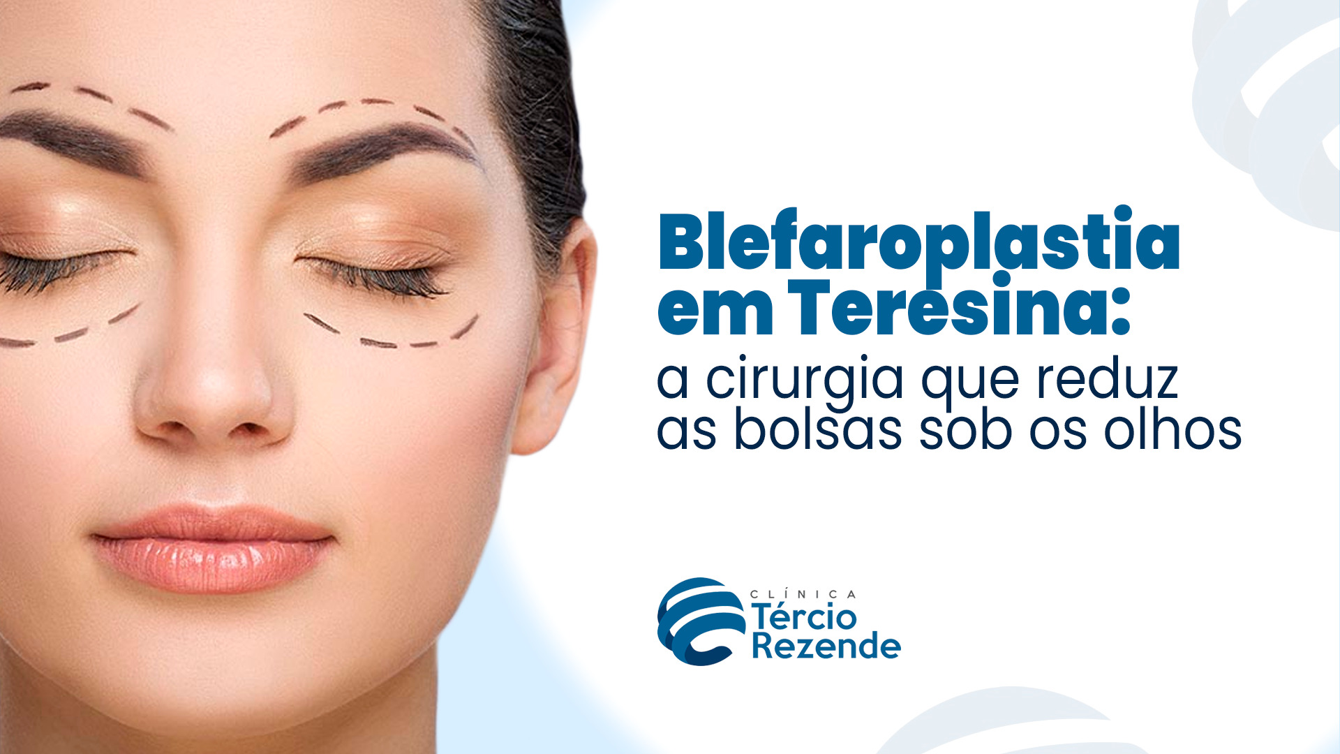 Blefaroplastia em Teresina: a cirurgia que reduz as bolsas sob os olhos